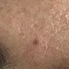 Quiero retirar un lunar del rostro