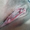 Tengo una labioplastia fallida con ambos labios menores abiertos ¿qué hago?