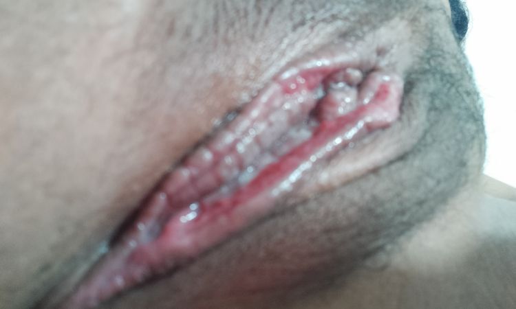 Tengo una labioplastia fallida con ambos labios menores abiertos ¿qué hago? - 82710