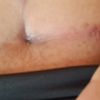 Cicatriz abdominoplastia