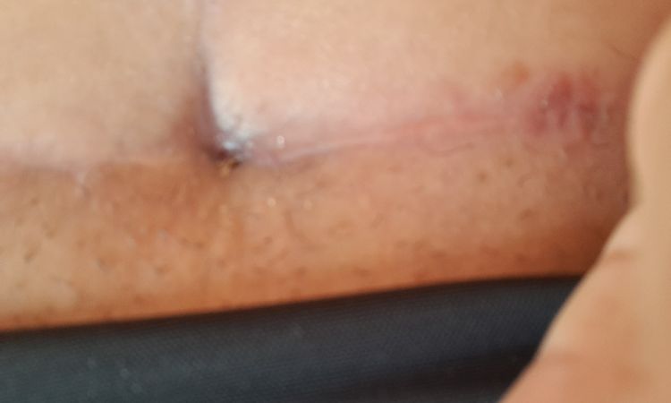 Cicatriz abdominoplastia - 83762