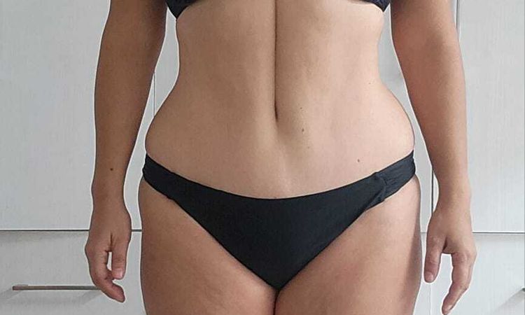 Línea en abdomen, post abdominoplastía - 84334