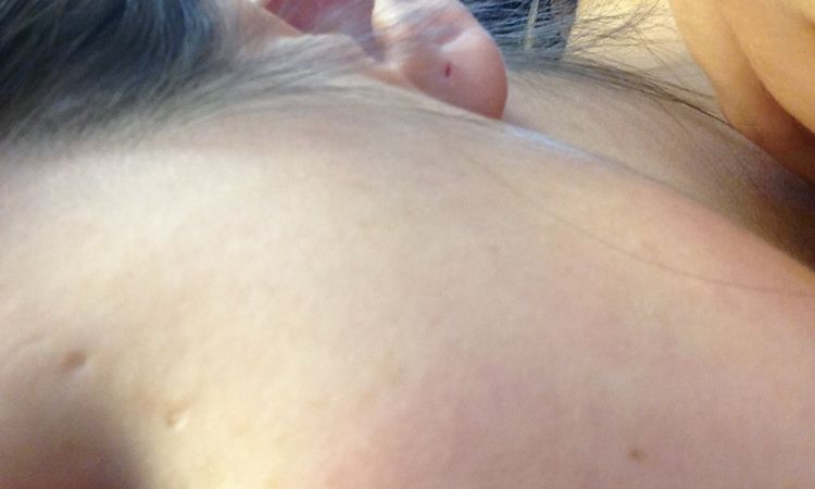 Cicatriz de piercing - 275