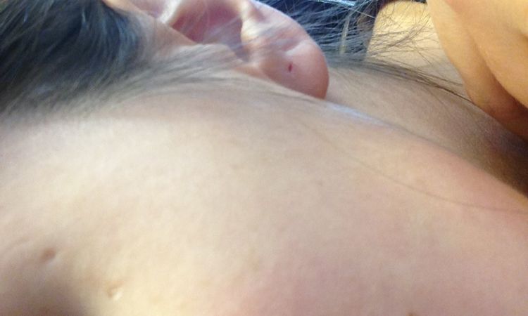 Cicatriz de piercing - 276