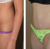 Tummy Tuck: La mini abdominoplastia (cuanto vale?)