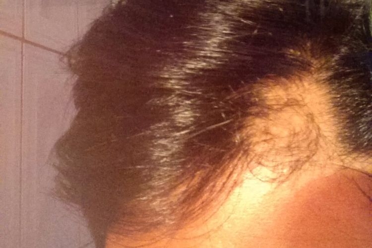 Tengo un pequeño pelon un poco arriba de mi frente