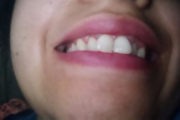Carillas de porcelana para dientes chuecos