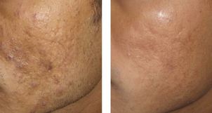 Antes y después de borrar cicatrices