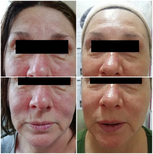 Resultados peeling