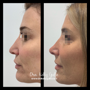 Rinomodelacion antes y después