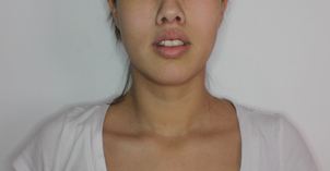 Aumento de labios con liplift