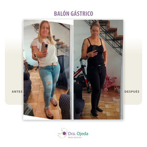 antes y después balón gástrico