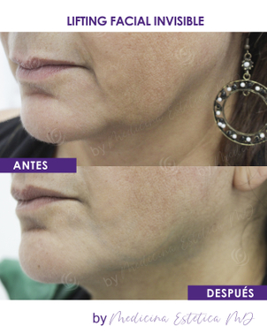 Antes y después de lifting