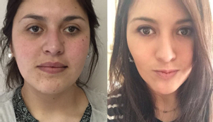 Resultados bichectomía