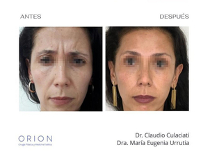 botox antes y después
