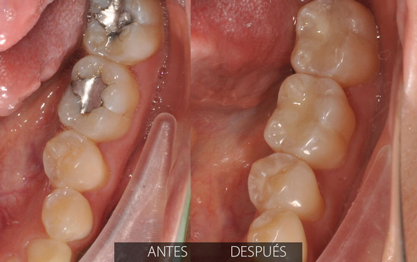 resultados después de una endodoncia