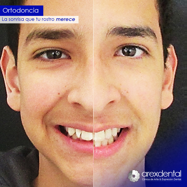 antes y después de ortodoncia