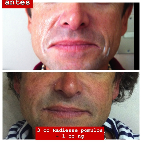 antes y después de rejuvenecimiento facial 