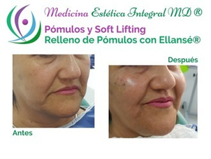 Antes y después aumento pómulos