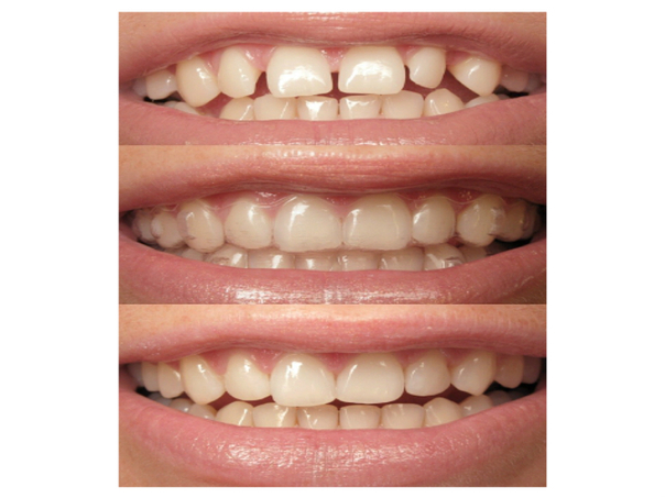 Antes y después de ortodoncia invisible