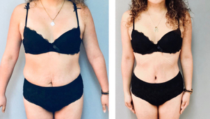 Resultado abdominoplastia