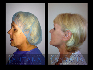 Paciente antes y después lifting