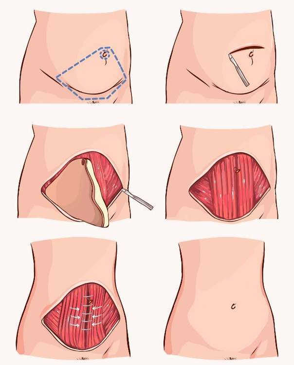 Como se realiza la abdominoplastia