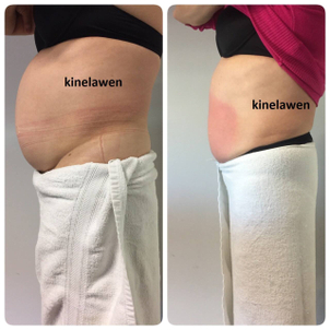 Antes y Despues de usar la cavitación