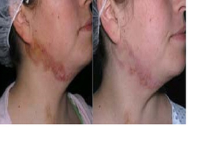 procedimiento para borrar cicatrices