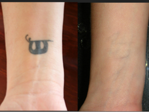 Resultados borrar tatuaje