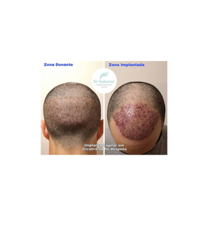 Implante capilar en Chile