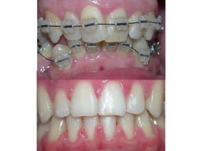 Resultados de los brackets