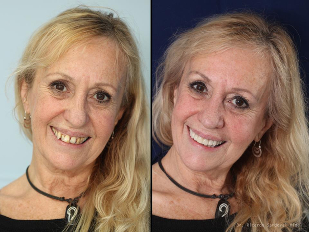 ¿Cómo es la recuperación de una intervención de implante dental?