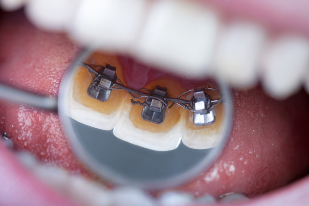 tratamiento de ortodoncia lingual