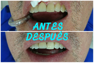 antes y después blanqueamiento dental