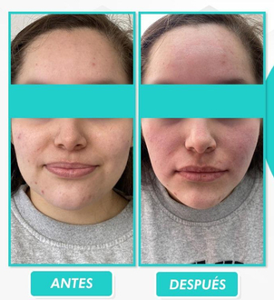 Antes y después bichectomía