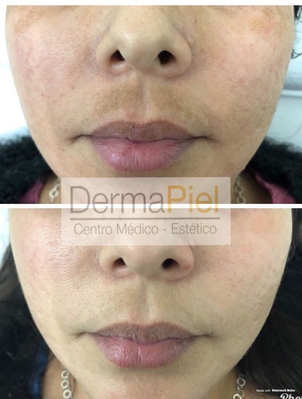 antes y después de peeling