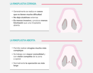 Técnicas de rinoplastia