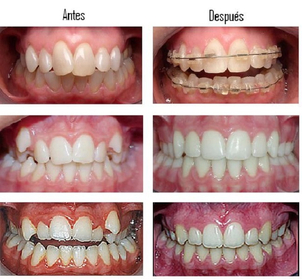 resultados de un tratamiento con brackets