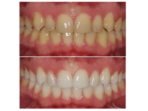 limpieza dental en chile
