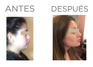 Eliminar bolas de bichat