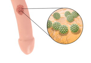 diagnostico de condilomas