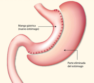 cirurgía estómago