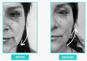 Resultados de los hilos tensores