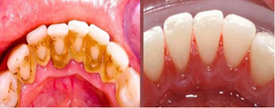 limpieza de dientes