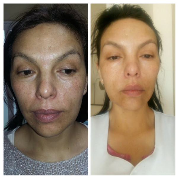 antes y después de la mesoterapia