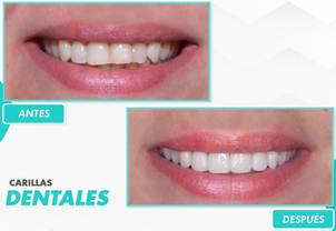 Antes y después de las carillas