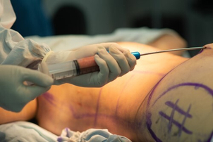 Lipoescultura