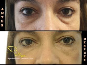 antes y después ojeras