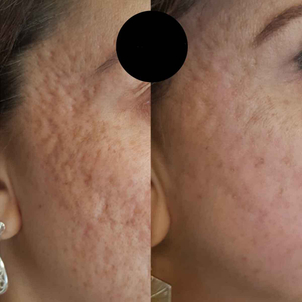 Antes y después de tratamiento acné